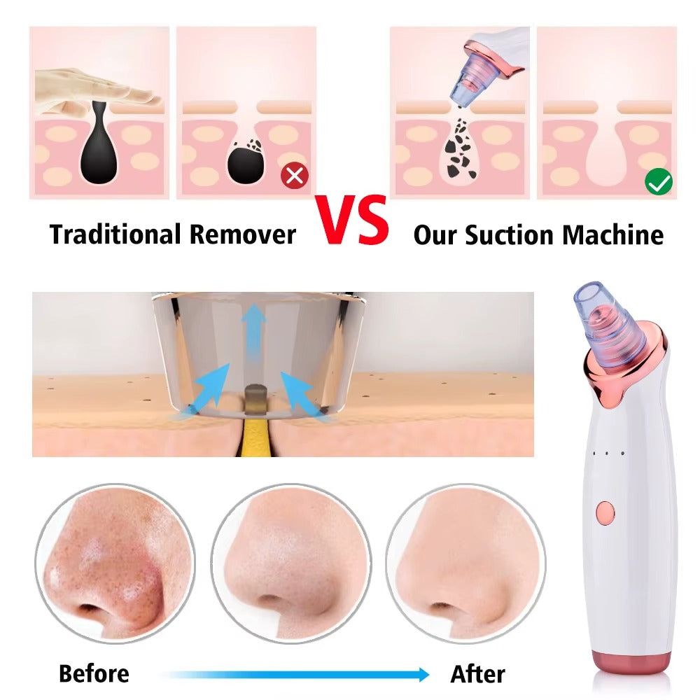Electric Facial Blackhead Remover | Chill Fun Mall